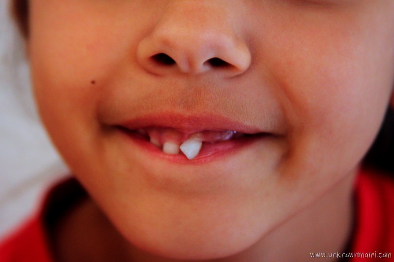 Baby tooth about to fall out